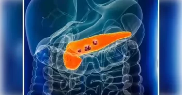 Studies reveal people with type 2 diabetes for over five years may face nearly double the risk of pancreatic and liver cancer.